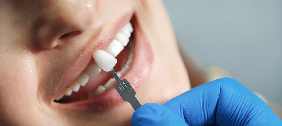 Nakładanie licówek na zęby w gabinecie Adenta