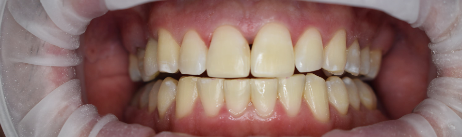 Leczenie ortodontyczne dorosłych