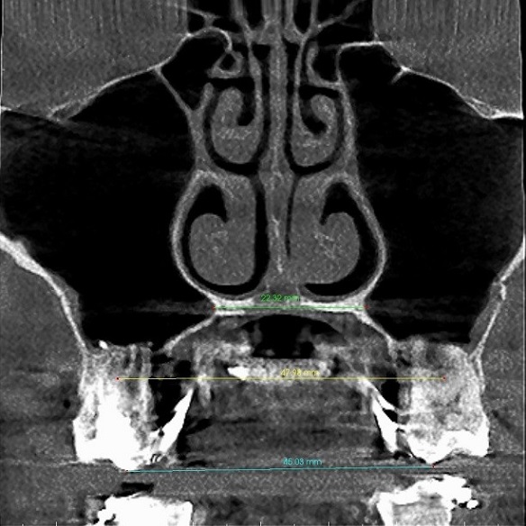 Przekrój czołowy po ekspansji