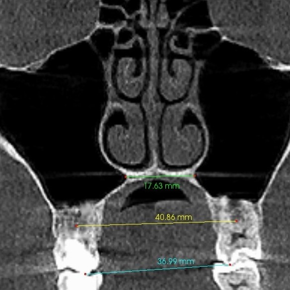 Przekrój czołowy przed ekspansją