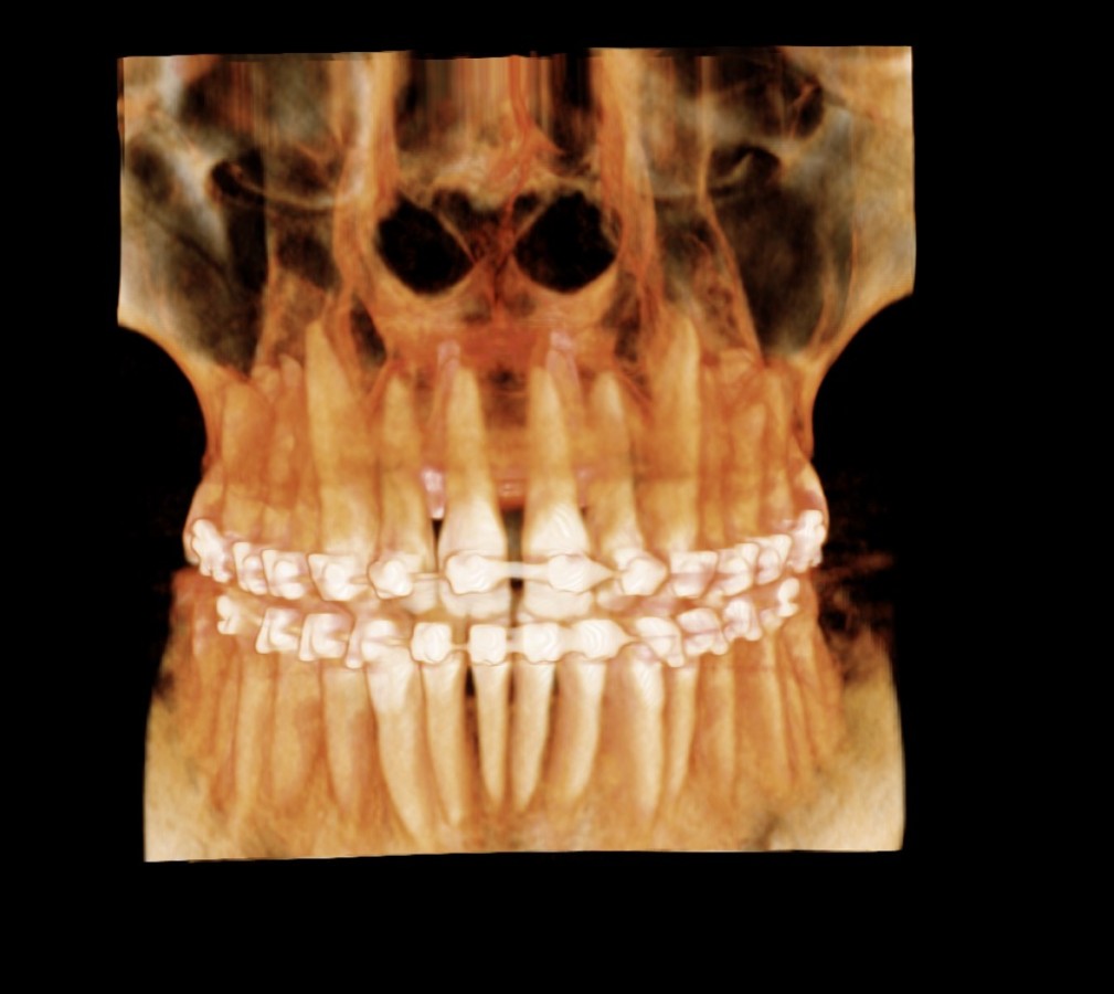Przekrój szczęki rok po leczeniu.