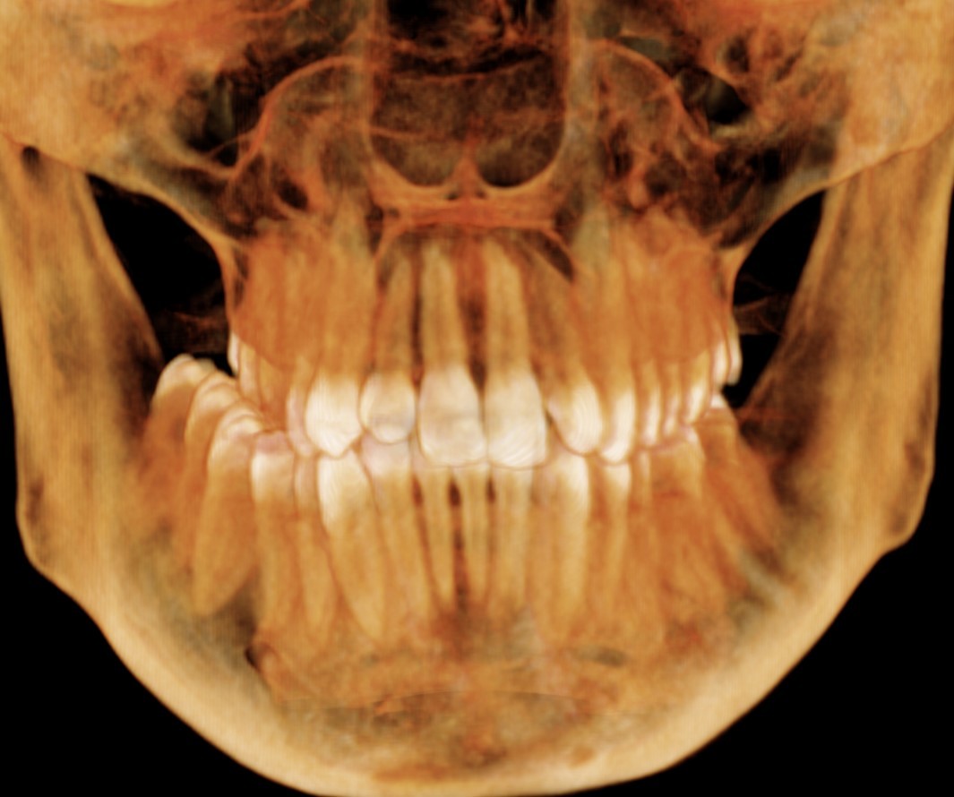 Przekój szczęki przed leczeniem